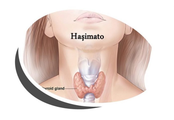 HAŞİMATO HASTALIĞI NEDİR?